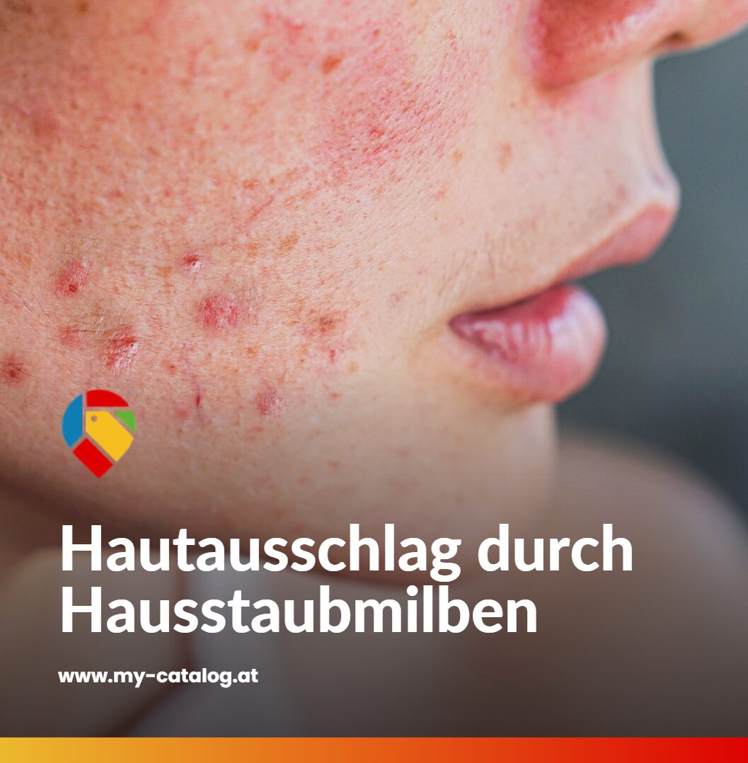 Hautausschlag durch Hausstaubmilben Hautausschlag durch Hausstaubmilben